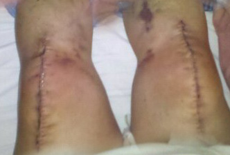 knee surgery staples